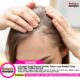 5 Vitamin untuk Rambut Rontok, Bantu Jaga Rambut Tetap Sehat